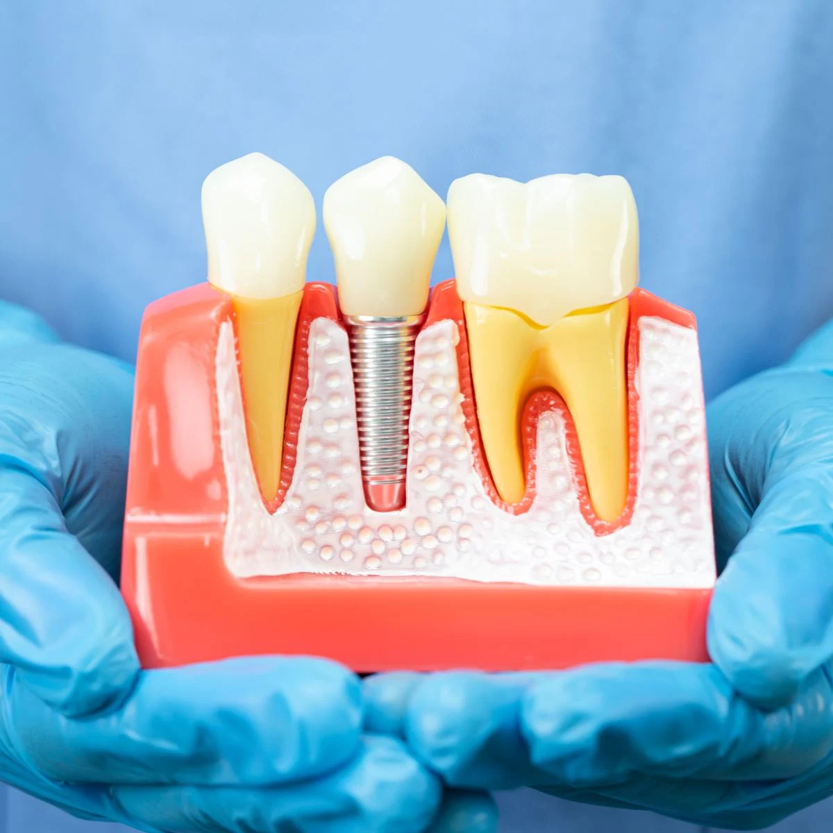 dental-implants Services - Dental Implants