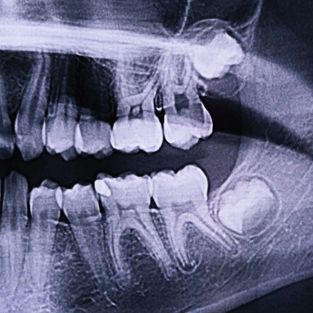 wisdom-teeth-and-extractions Services - Wisdom Teeth and Extractions