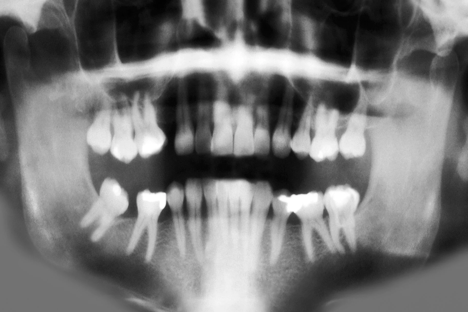 9 Signs Your Wisdom Teeth Need to Come Out - Featured Image