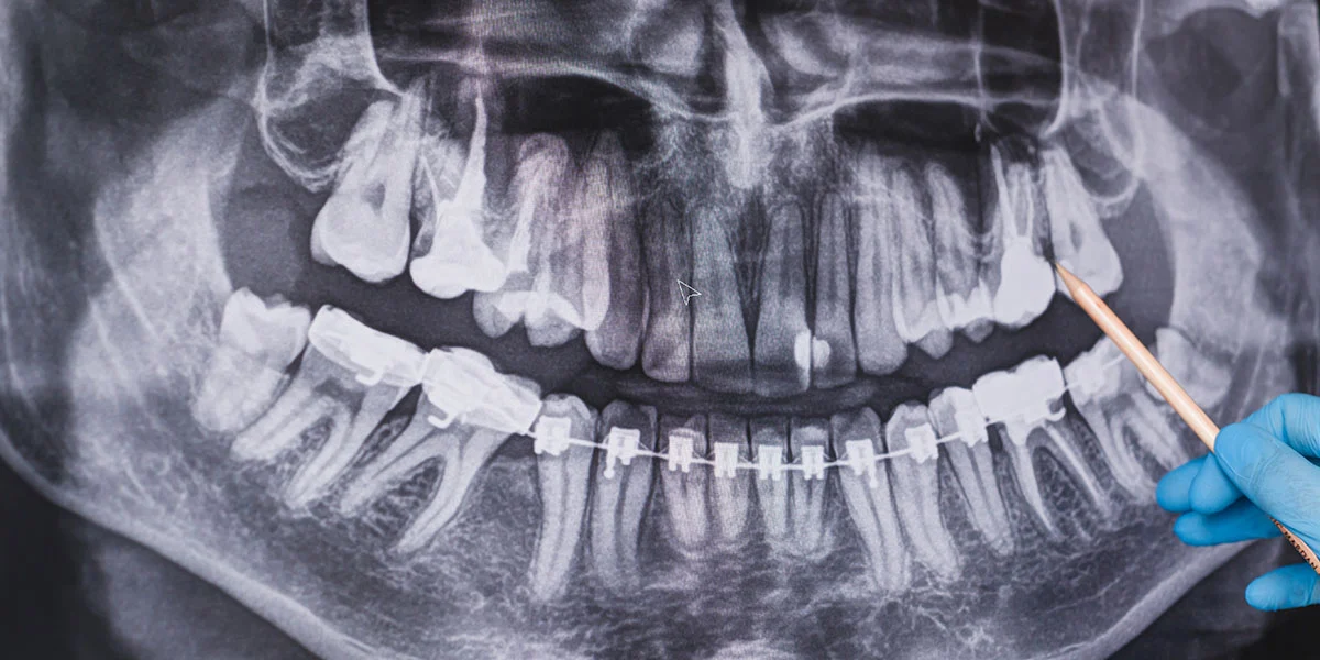 How Long Does Wisdom Tooth Recovery Really Take - Image 2