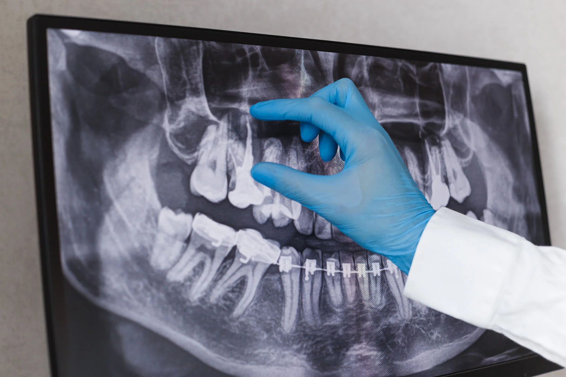 Is a Root Canal Really Painful - Featured Image