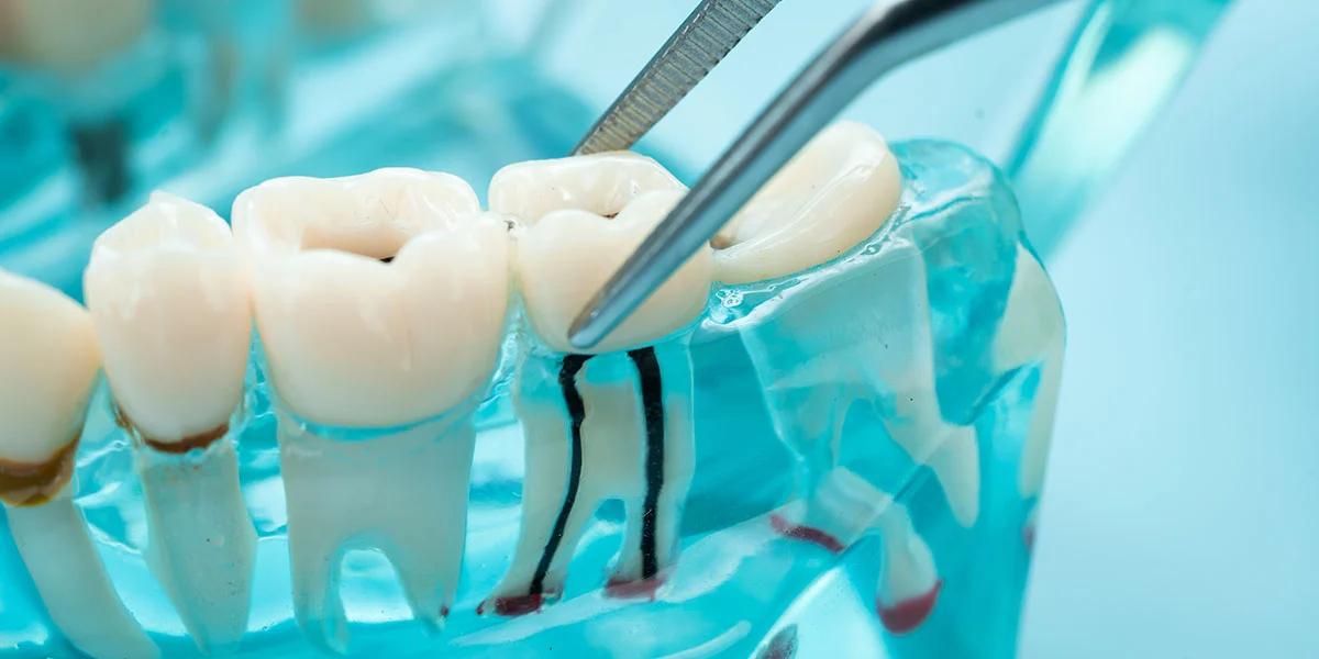 Is a Root Canal Really Painful - Image 2