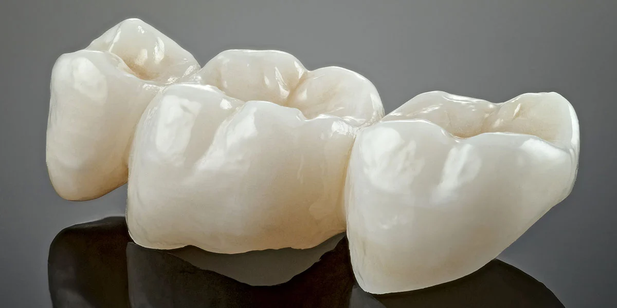 What Is Crown Lengthening and Why Might You Need It – Image 1 What Is Crown Lengthening and Why Might You Need It - Image 1