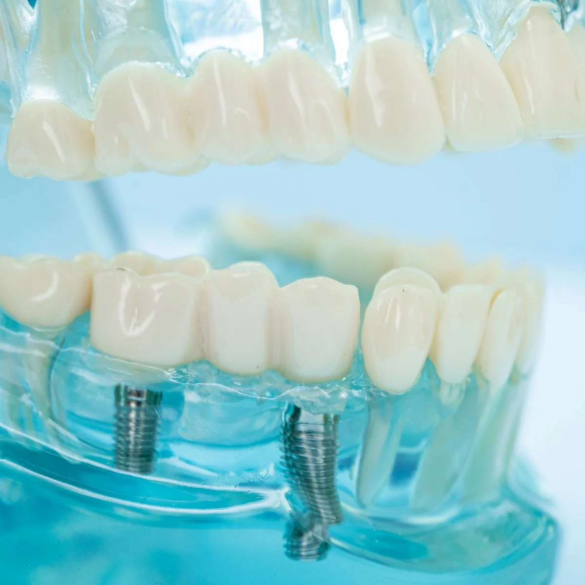 Dental implants Ajax