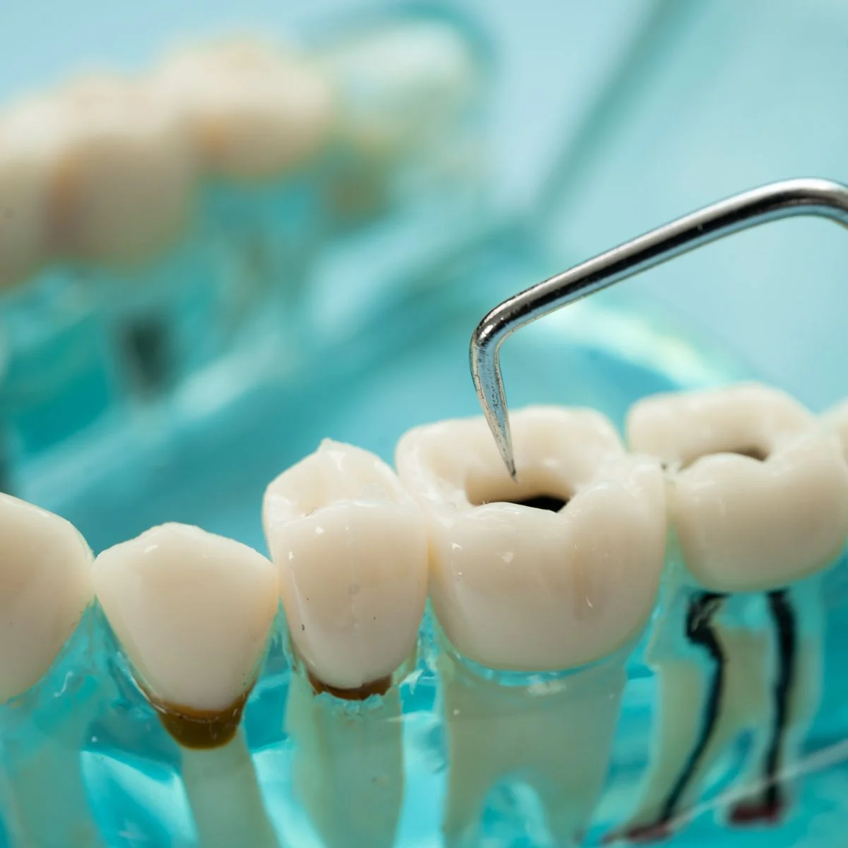Endodontics – Image 1 Endodontics - Image 1